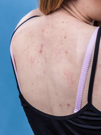 Health problem, skin diseases. Young woman showing her back with allergy rash acneの写真素材