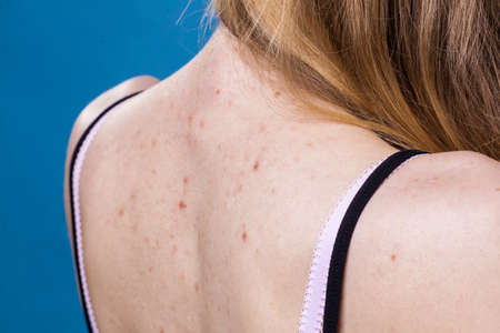 Health problem, skin diseases. Young woman showing her back with allergy rash acne