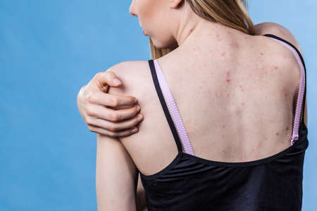 Health problem, skin diseases. Young woman showing her back with acne, red spots. Teen girl scratching her shoulder with pimples.の写真素材