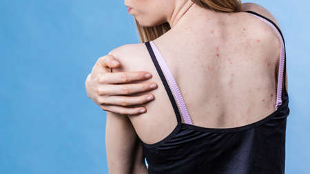 Health problem, skin diseases. Young woman showing her back with acne, red spots. Teen girl scratching her shoulder with pimples.の写真素材