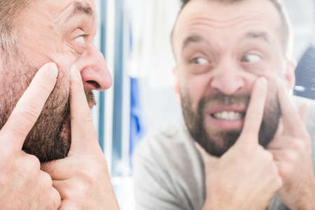 Adult man investigating his pimples on face. Guy trying to get rid of pimple squeezing it.の写真素材