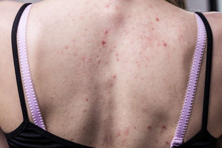 Health problem, skin diseases. Young woman showing her back with allergy rash acneの写真素材