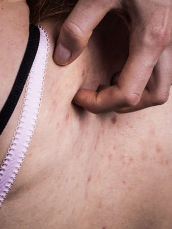 Health problem, skin diseases. Young woman showing her back with acne, red spots. Teen girl scratching her shoulder with pimples.の写真素材