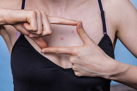 Woman having pimples, red spots on her chest. Dermatoses, skin condition problems, dermatological...
