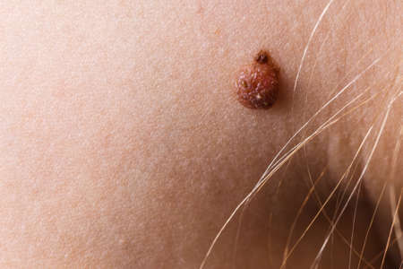 Skin disease. Closeup brown mole on caucasian human body.