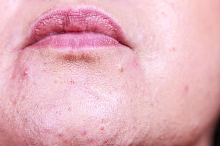 Mature woman showing her face with acne and moles. Adult female no make up with red spots on her chin. Health problem, skin diseases.の写真素材