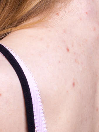 Health problem, skin diseases. Young woman showing her back with allergy rash acne