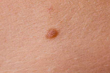 Skin disease. Closeup brown mole on caucasian human body.