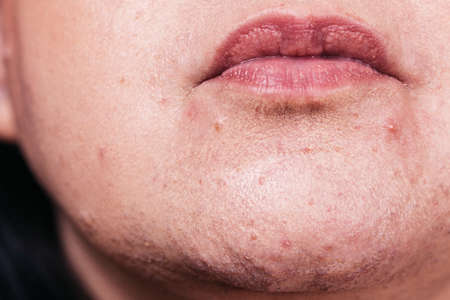 Mature woman showing her face with acne and moles. Adult female no make up with red spots on her chin. Health problem, skin diseases.の写真素材
