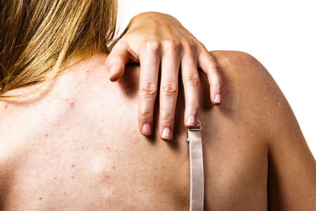 Health problem, skin diseases. Young woman showing her back with acne, red spots. Teen girl...