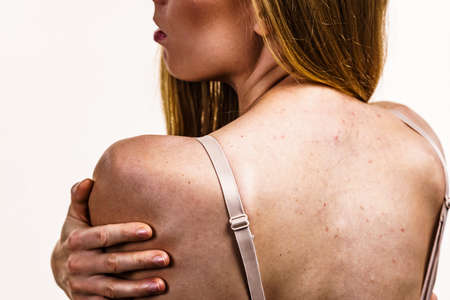 Health problem, skin diseases. Young woman showing her back with acne, red spots. Teen girl with many pimples.の写真素材