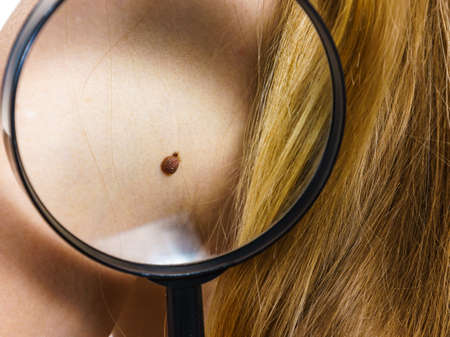 Skin disease. Closeup brown mole on human body. Female checking moles using magnifying glass.