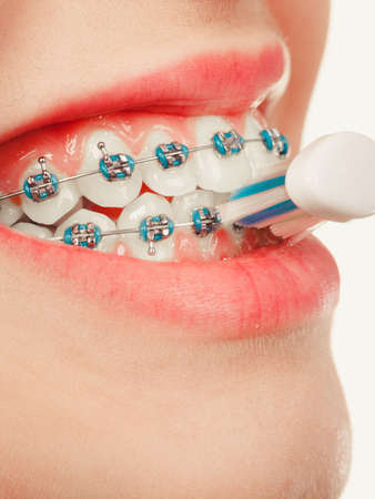 Dentist and orthodontist concept. Young woman smiling cleaning and brushing teeth with blue braces using toothbrushの写真素材
