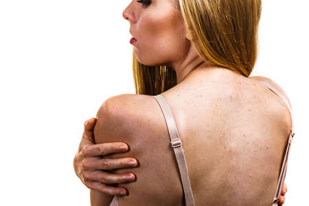 Health problem, skin diseases. Young woman showing her back with acne, red spots. Teen girl with...