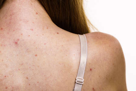 Health problem, skin diseases. Young woman showing her back with acne, red spots. Teen girl with...