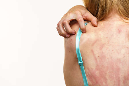 Young woman suffering from itching on her skin and scratching itchy back. Allergic reaction to food,...