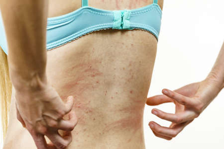Itchy skin, dermatitis, food allergies. Woman showing her back with acne, red spots. Female having...