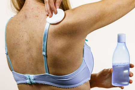 Health problem, skin diseases. Young woman with acne, red spots on back. Female cleaning skin, using...