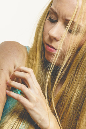 Itchy skin, dermatitis, food allergies. Woman having itching, scratching her arm with allergy rash.の写真素材
