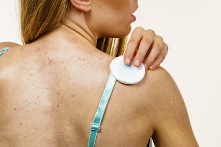 Health problem, skin diseases. Young woman with acne, red spots on back. Female cleaning skin, using a cotton pad.の写真素材