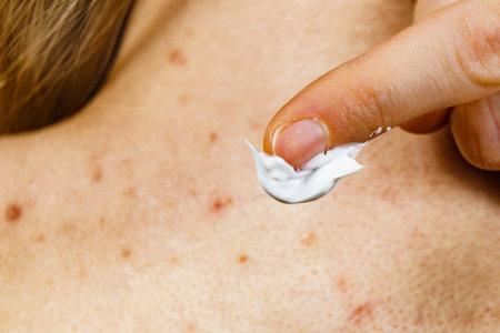 Problematic skin in adolescents. Woman with acne red spots on neck. Female applying medical ointment on pimples.の写真素材