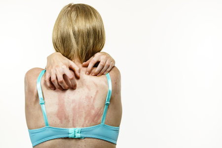 Young woman suffering from itching on her skin and scratching itchy back. Allergic reaction to food, dermatitis. health care.の写真素材