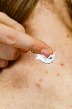 Problematic skin in adolescents. Woman with acne red spots on neck. Female applying medical ointment on pimples.の写真素材