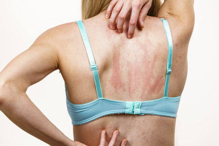 Health problem, skin diseases. Young woman showing her back with acne, red spots. Female scratching her itchy body with allergy rash.の写真素材