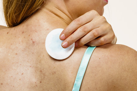 Health problem, skin diseases. Young woman with acne, red spots on back. Female cleaning skin, using a cotton pad.の写真素材