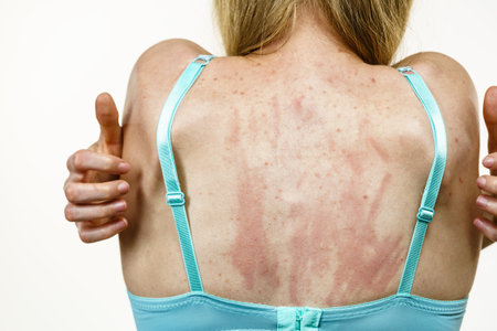 Young woman suffering from itching on her skin and scratching itchy back. Allergic reaction to food, dermatitis. health care.の写真素材