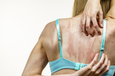 Young woman suffering from itching on her skin and scratching itchy back. Allergic reaction to food, dermatitis. health care.の写真素材