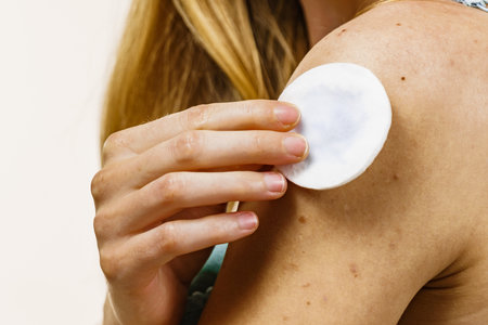 Health problem, skin diseases. Young woman with acne, red spots on arm. Female cleaning skin, using cotton pad.の写真素材