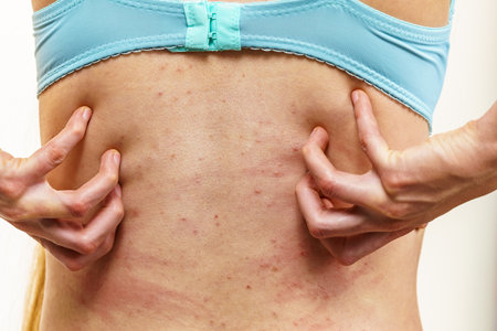 Itchy skin, dermatitis, food allergies. Woman showing her back with acne, red spots. Female having itching, scratching her body with allergy rash.の写真素材