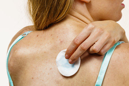 Treatment for adult acne problem. Woman with red spots on back. Female cleaning skin, using cotton pad.の写真素材