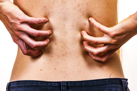 Health problem, skin diseases. Young woman showing her back with acne, red spots. Teen girl...