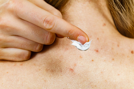 Health problem, skin diseases. Woman with acne red spots on neck. Female applying medical ointment...