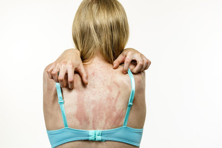Young woman suffering from itching on her skin and scratching itchy back. Allergic reaction to food, dermatitis. health care.の写真素材