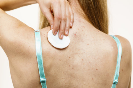 Treatment for adult acne problem. Woman with red spots on back. Female cleaning skin, using cotton pad.の写真素材