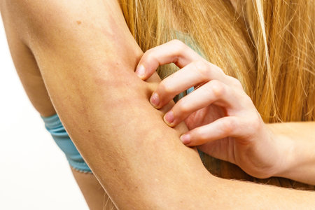 Itchy skin, dermatitis, food allergies. Woman having itching, scratching her arm with allergy rash.