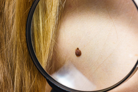 Closeup of brown mole on human body. Female checking moles using magnifying glass.の写真素材