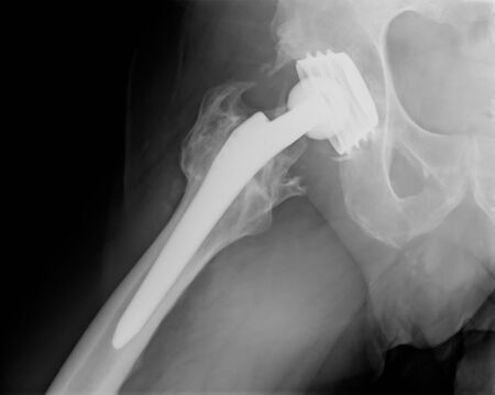 Xray imaging of permanent total hip arthroplasty