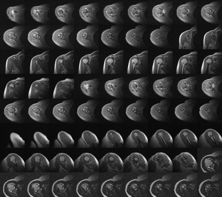 MRI showing massive tear of the rotator cuff tendon with retraction of the supraspinatus, the infraspinatus and partial tear of the subscapularis