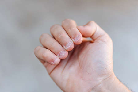 A man's hand with bitten and ugly fingernails. Bad care of handsの写真素材