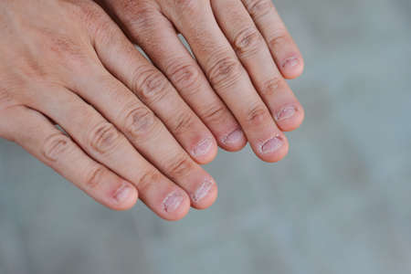 Close up detail of two hands with bitten and ugly nailsの写真素材