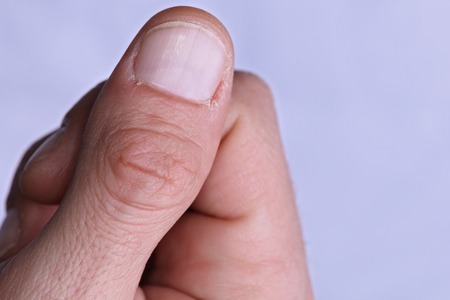 Man hands close up, dry cuticle, rough skin care conceptの写真素材
