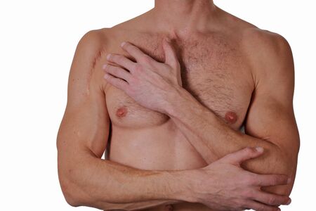 Man man with scar on his hand shoulder isolated on white background. Laser Scar Reduction conceptの写真素材