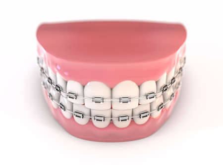 A pair of upper and lower sets of perfect human teeth fitted with steel dental braces on an isolated background - 3D renderの写真素材