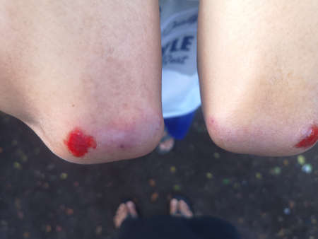 scratches on the skin from a motorcycle accident. blood wounds on the feet and hands after falling onto the highwayの写真素材