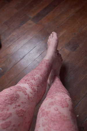 View of leg and feet of woman with Psoriasisの写真素材