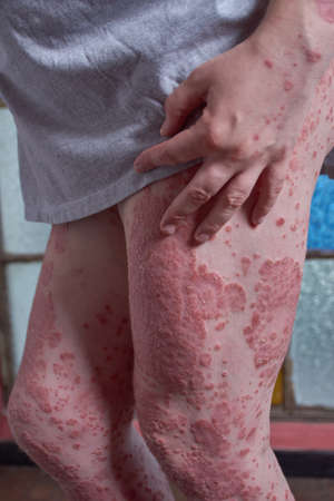 View of thigh of woman with Psoriasisの写真素材